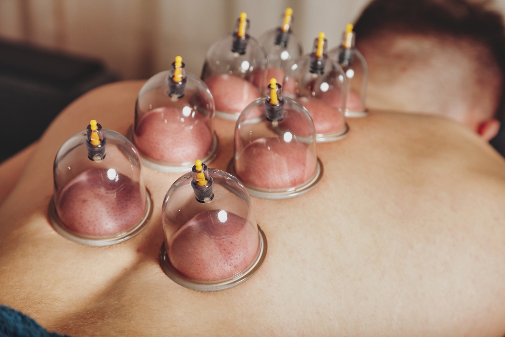 Wet Cupping