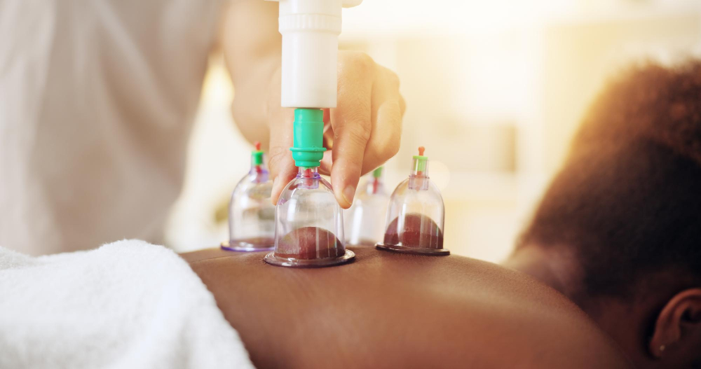 Cupping 