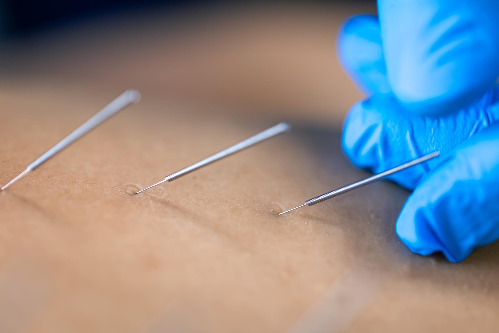 Acupuncture 