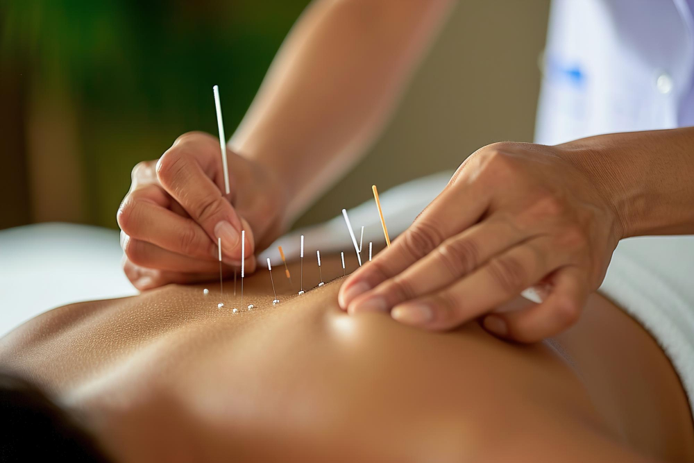 Acupuncture